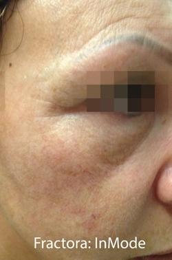 Fractora Before & After Patient #11694