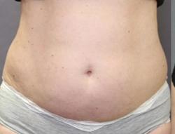 BodyFX Before & After Patient #11659