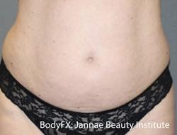 BodyFX Before & After Patient #11659