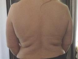 BodyFX Before & After Patient #11660