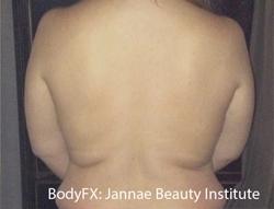 BodyFX Before & After Patient #11660