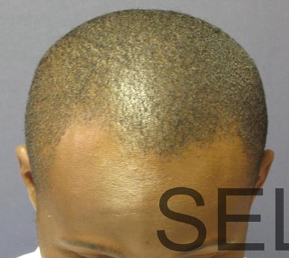 PRP For Hair Loss Before & After Patient #11568