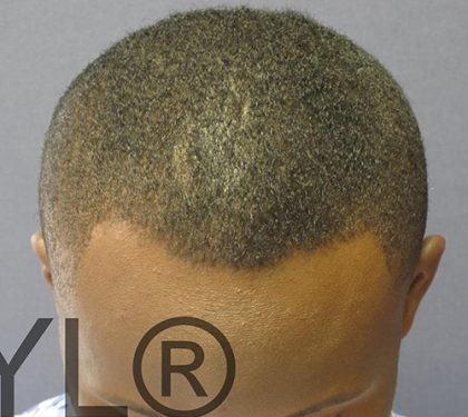 PRP For Hair Loss Before & After Patient #11568