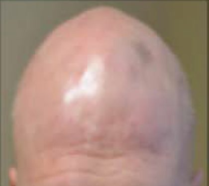 PRP For Hair Loss Before & After Patient #11549