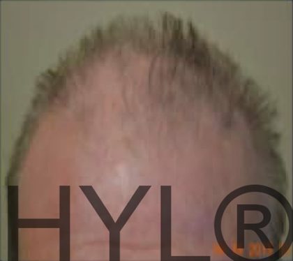 PRP For Hair Loss Before & After Patient #11549