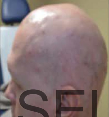 PRP For Hair Loss Before & After Patient #11549