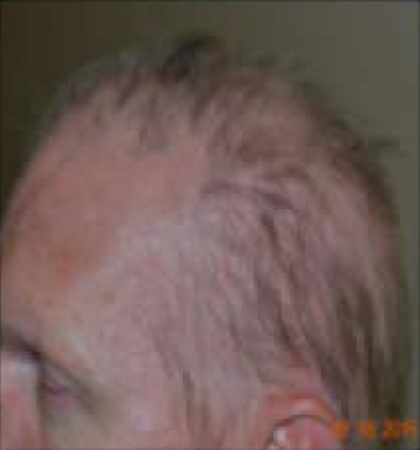 PRP For Hair Loss Before & After Patient #11549