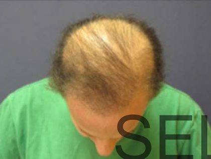 PRP For Hair Loss Before & After Patient #11557