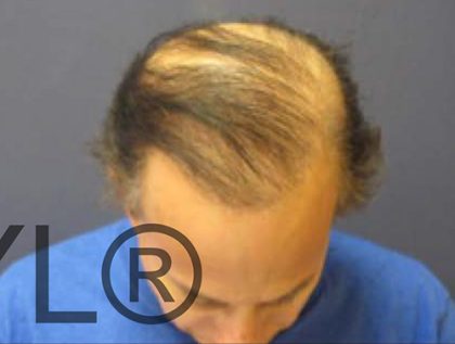 PRP For Hair Loss Before & After Patient #11557