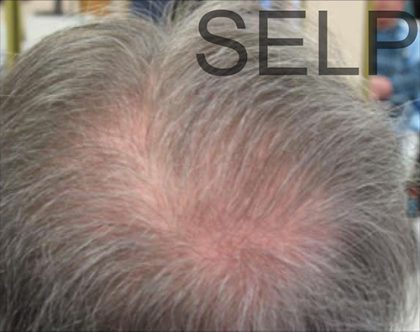 PRP For Hair Loss Before & After Patient #11560