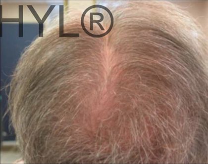 PRP For Hair Loss Before & After Patient #11560
