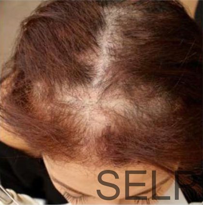 PRP For Hair Loss Before & After Patient #11563