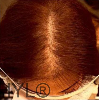 PRP For Hair Loss Before & After Patient #11563