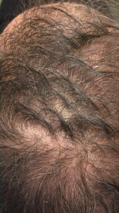 PRP For Hair Loss Before & After Patient #11565