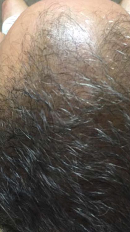 PRP For Hair Loss Before & After Patient #11565