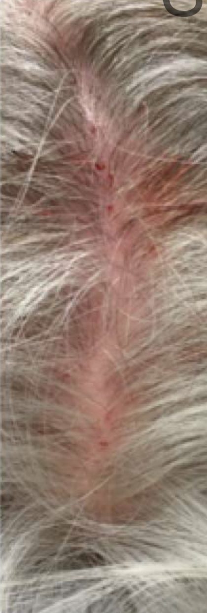 PRP For Hair Loss Before & After Patient #11567