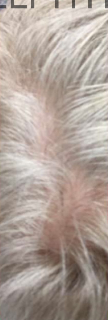 PRP For Hair Loss Before & After Patient #11567