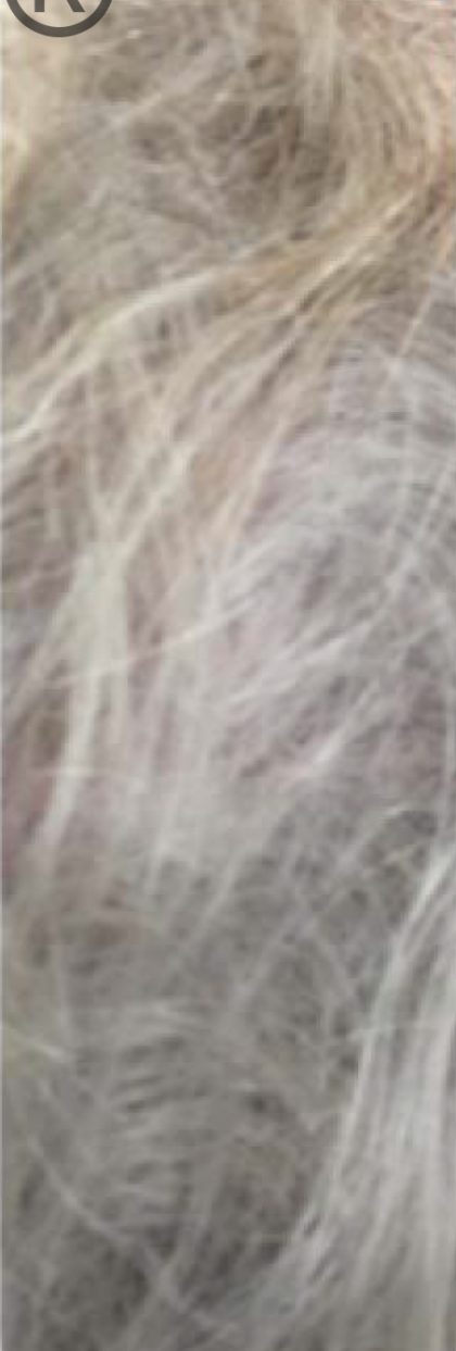 PRP For Hair Loss Before & After Patient #11567