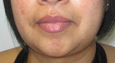 Chin Liposuction Before & After Patient #8332