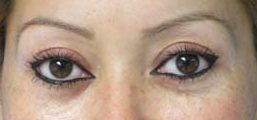 Eyelid Surgery Before & After Patient #8472
