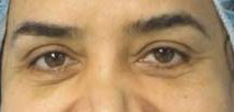 Eyelid Surgery Before & After Patient #8454