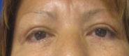 Eyelid Surgery Before & After Patient #8436
