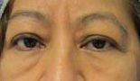 Eyelid Surgery Before & After Patient #8433