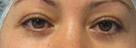 Eyelid Surgery Before & After Patient #8430