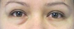 Eyelid Surgery Before & After Patient #8427