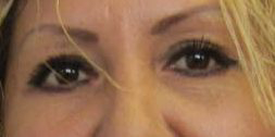 Eyelid Surgery Before & After Patient #8412