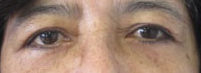 Eyelid Surgery Before & After Patient #8406