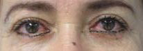 Eyelid Surgery Before & After Patient #8400