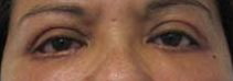 Eyelid Surgery Before & After Patient #8397