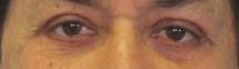 Eyelid Surgery Before & After Patient #8394