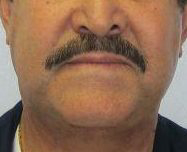 Neck Lift Before & After Patient #10039