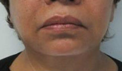Facelift Before & After Patient #8495