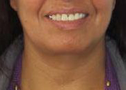 Facelift Before & After Patient #8487