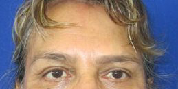 Facelift Before & After Patient #8481