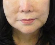 Neck Lift Before & After Patient #10055