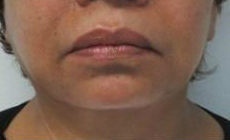 Neck Lift Before & After Patient #10034