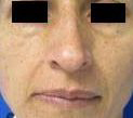 Rhinoplasty Before & After Patient #10313