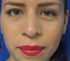 Rhinoplasty Before & After Patient #10306