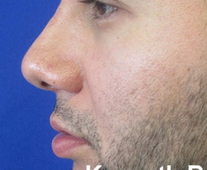 Rhinoplasty Before & After Patient #10293