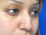 Rhinoplasty Before & After Patient #10269