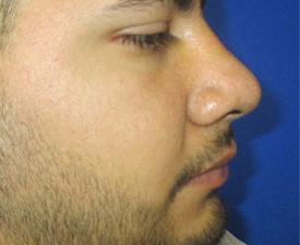 Rhinoplasty Before & After Patient #10219