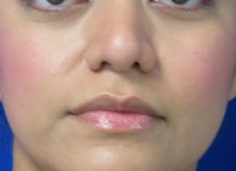 Rhinoplasty Before & After Patient #10150