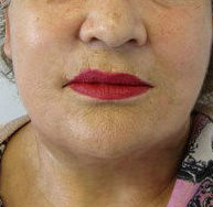 Brow Lift Before & After Patient #8129