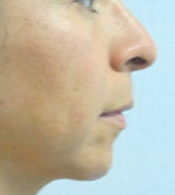 Rhinoplasty Before & After Patient #10142