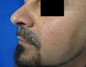 Chin Implant Before & After Patient #8312