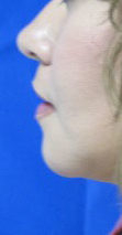 Chin Implant Before & After Patient #8302